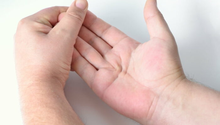 4 warning signs of Dupuytren’s contracture